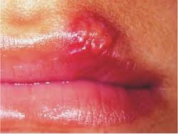 Herpes labialis